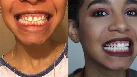 smile direct results